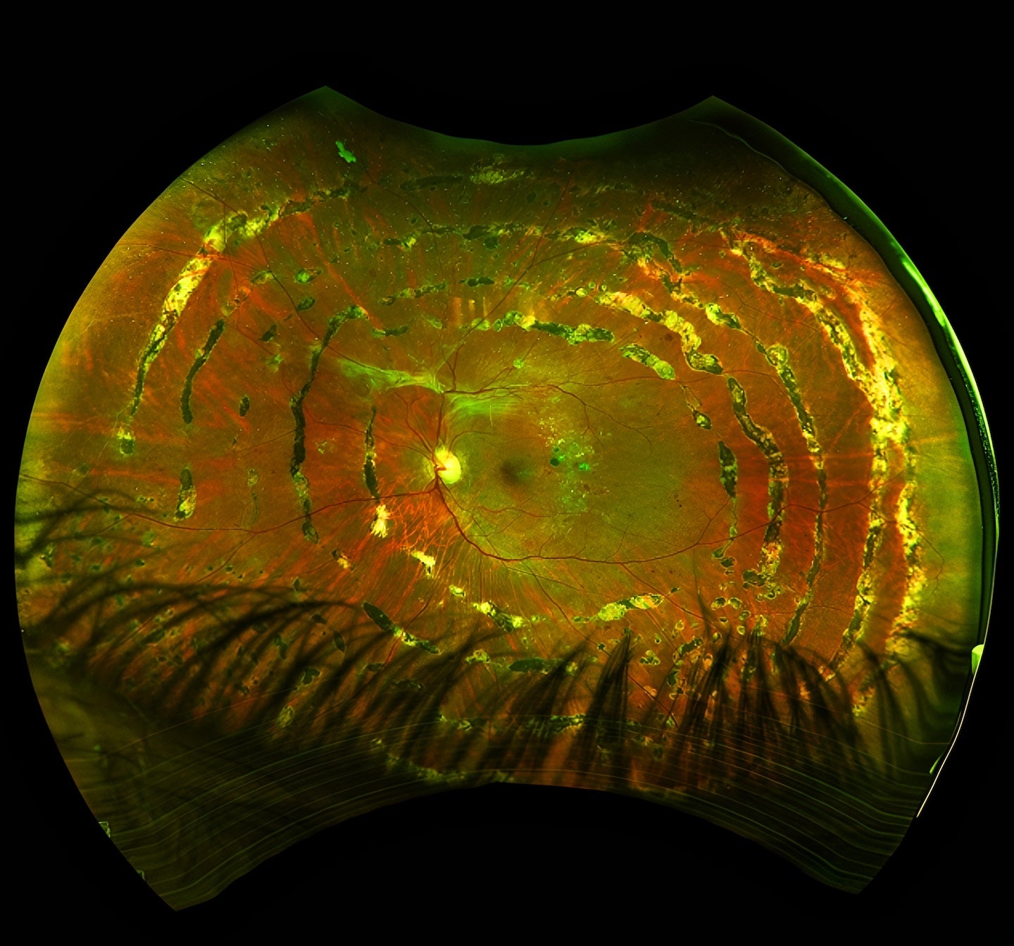 a close-up photo of a 47-year-old male’s eye, taken after panretinal photocoagulation for proliferative diabetic retinopathy